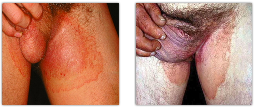 Ringworm on Body Treatment, Symptoms & Pictures